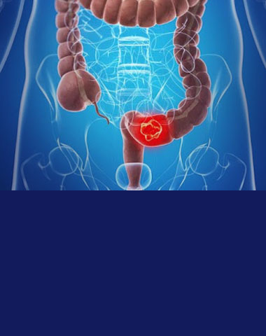 Hemorrhoid-Hemorrhoidectomy